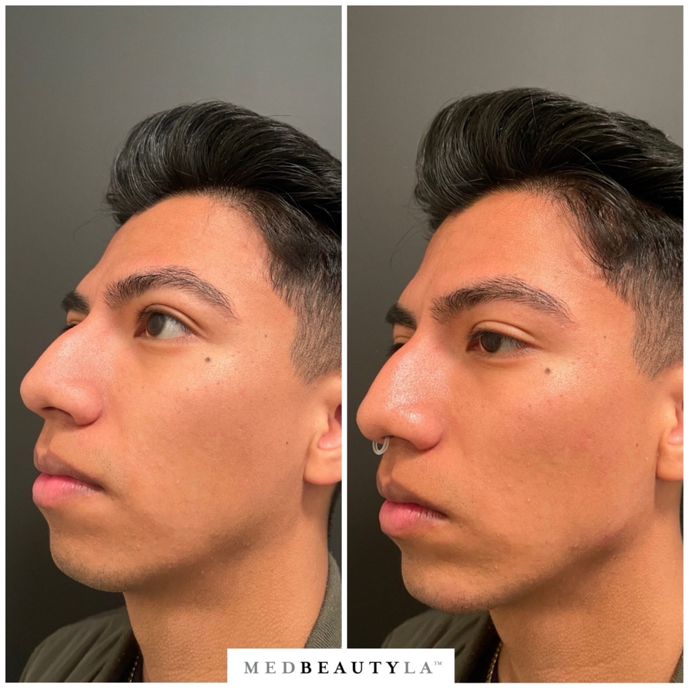 Male jawline enhancement before and after at MedBeautyLA: a young man's chin brought forward for a more balanced profile