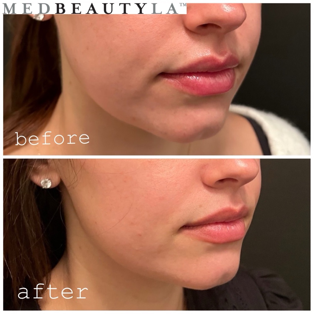 Masseter Botox before and after at MedBeautyLA, showing a slimmer, more tapered jawline