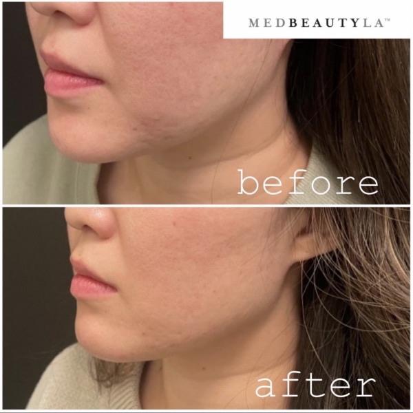 Masseter Botox before and after at MedBeautyLA: a wide lower face and jaw refined into a softer, slimmer contour