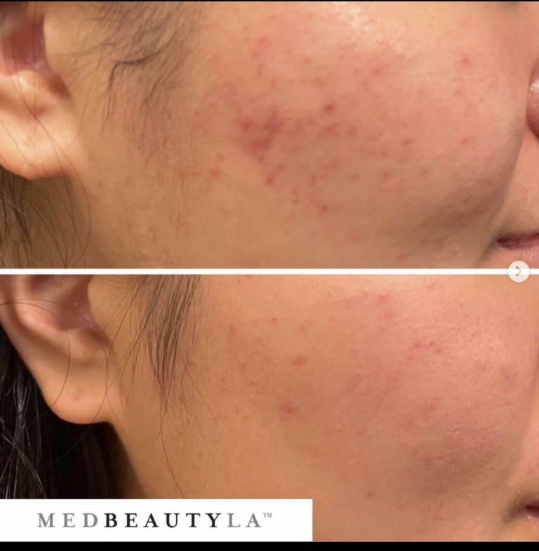 MedBeautyLA client before and after: red acne breakouts on the cheek noticeably calmer and clearer