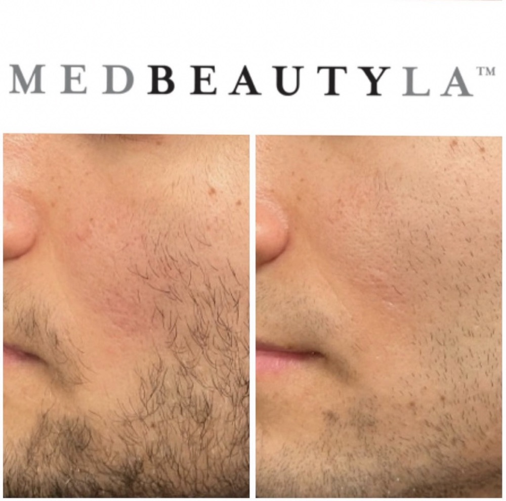 MedBeautyLA male client before and after: redness and irritation on the cheek and beard area noticeably calmer