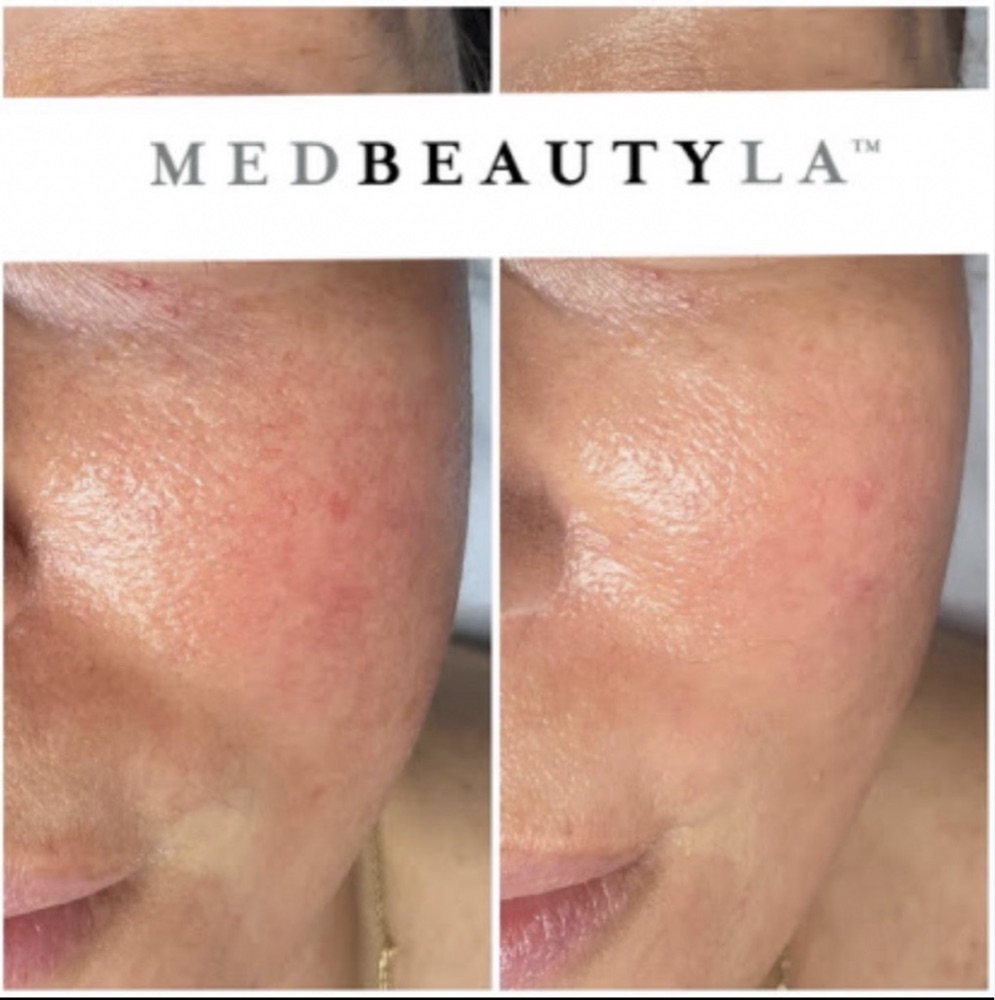MedBeautyLA client before and after: redness on the cheek calmer and skin tone more even