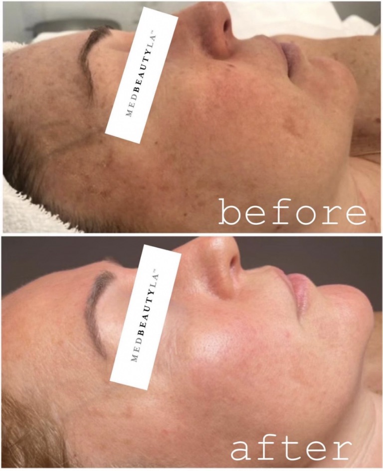 MedBeautyLA client before and after: sun spots and uneven pigment on the cheek visibly cleared and brighter