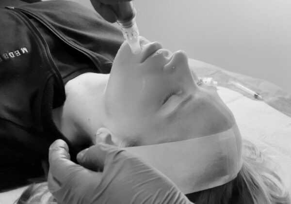 A MedBeautyLA provider applying exosomes to a client's face with a dropper right after microneedling