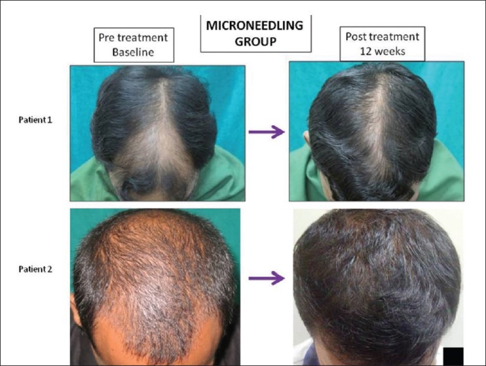 Top-down scalp photos of two men from a clinical study, before microneedling and after 12 weeks of treatment, showing visibly fuller hair over the crown