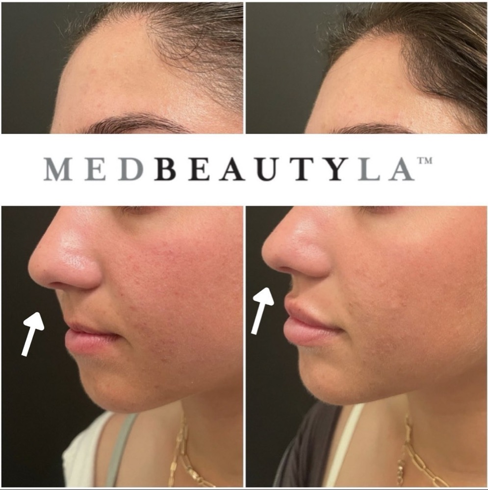 Nose tip lift before and after at MedBeautyLA, side profile with arrows showing a lifted nasal tip