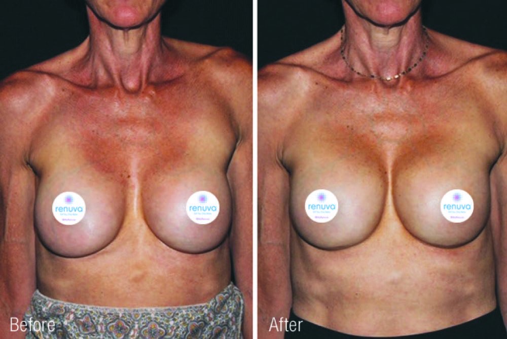 Renuva before and after on the breasts, with increased volume at the top of the breasts