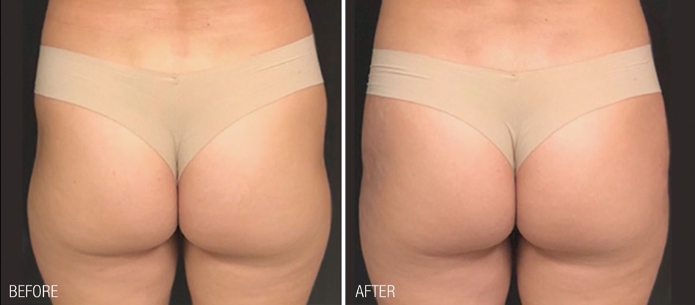 Renuva before and after on the buttocks, with a fuller, lifted shape