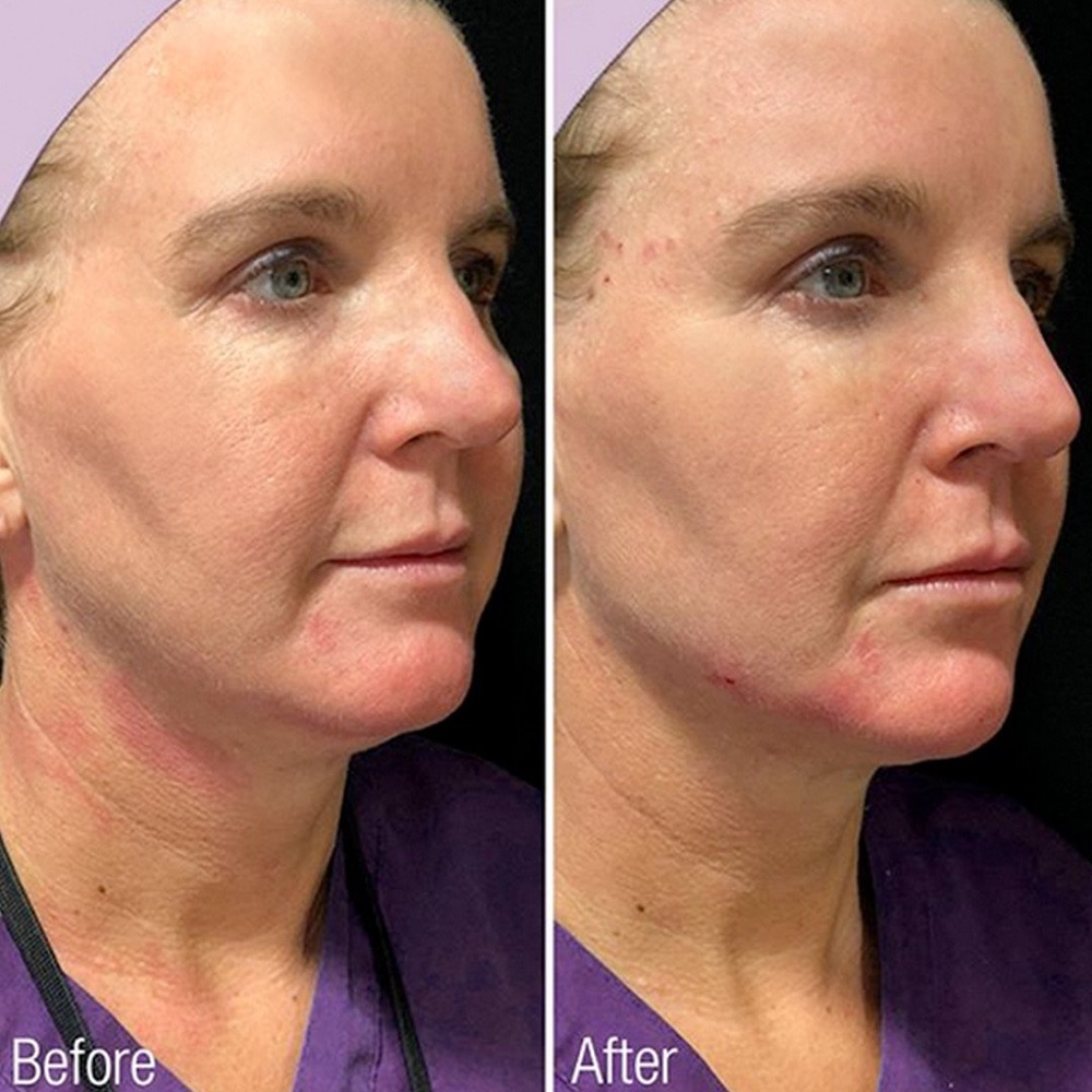 Renuva before and after, three-quarter view of a woman's face with smoother jawline and lower face after treatment