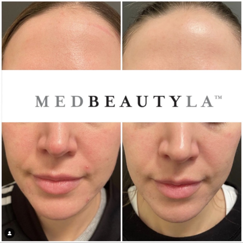 ResurFX before and after at MedBeautyLA: forehead redness and breakouts on the chin calmer after one session