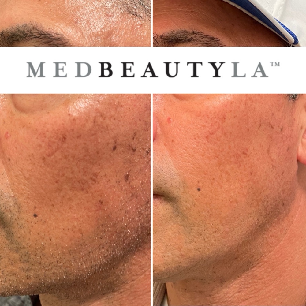 ResurFX and IPL before and after at MedBeautyLA: brown spots and sun damage on a man's cheek visibly cleared