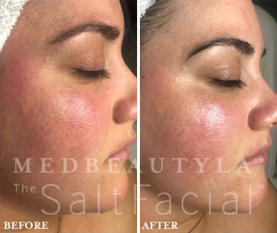 MedBeautyLA client before and after The SaltFacial: redness on the cheek calmer and skin brighter and more even