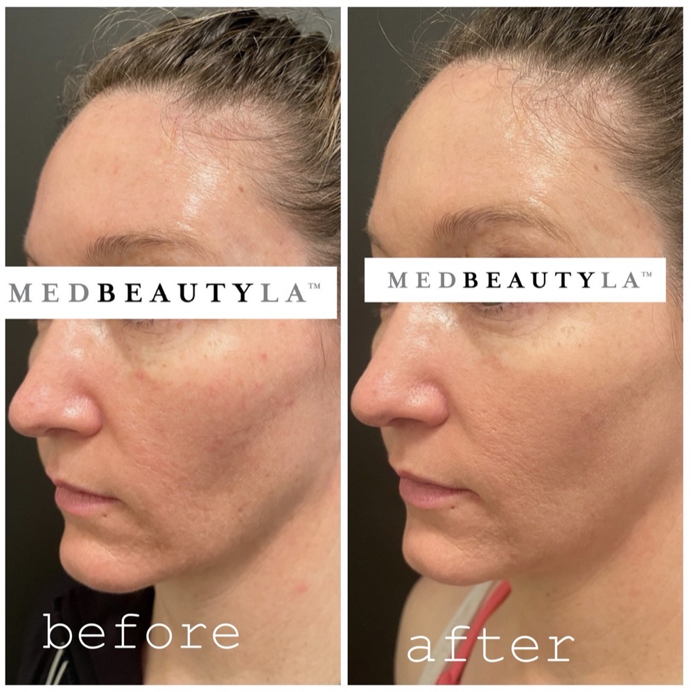 Sculptra before and after at MedBeautyLA: fuller cheeks and smoother skin from collagen rejuvenation