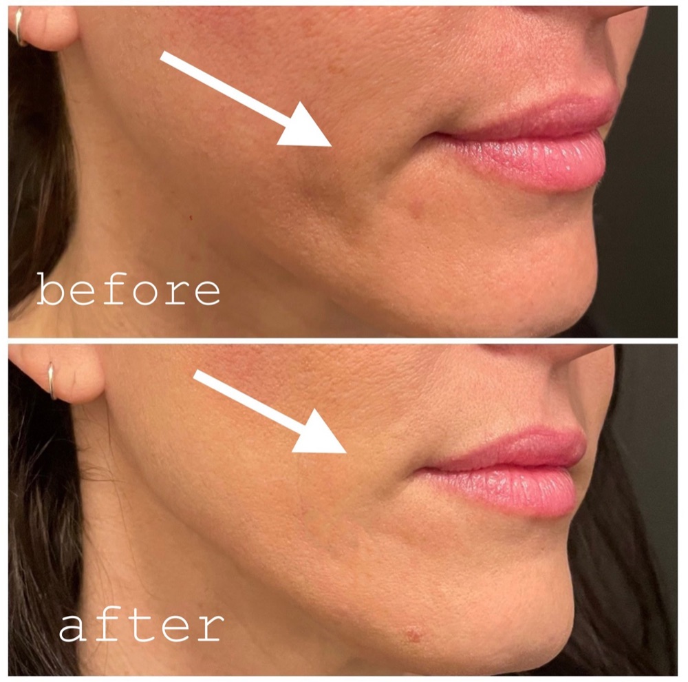 Sculptra before and after on the marionette lines, with softer lines beside the mouth after two sessions