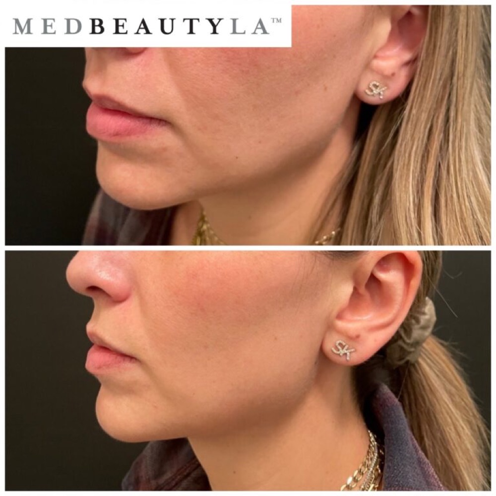 Non-surgical skin tightening before and after at MedBeautyLA: side profile of a woman's lower face showing a firmer, more defined jawline after treatment