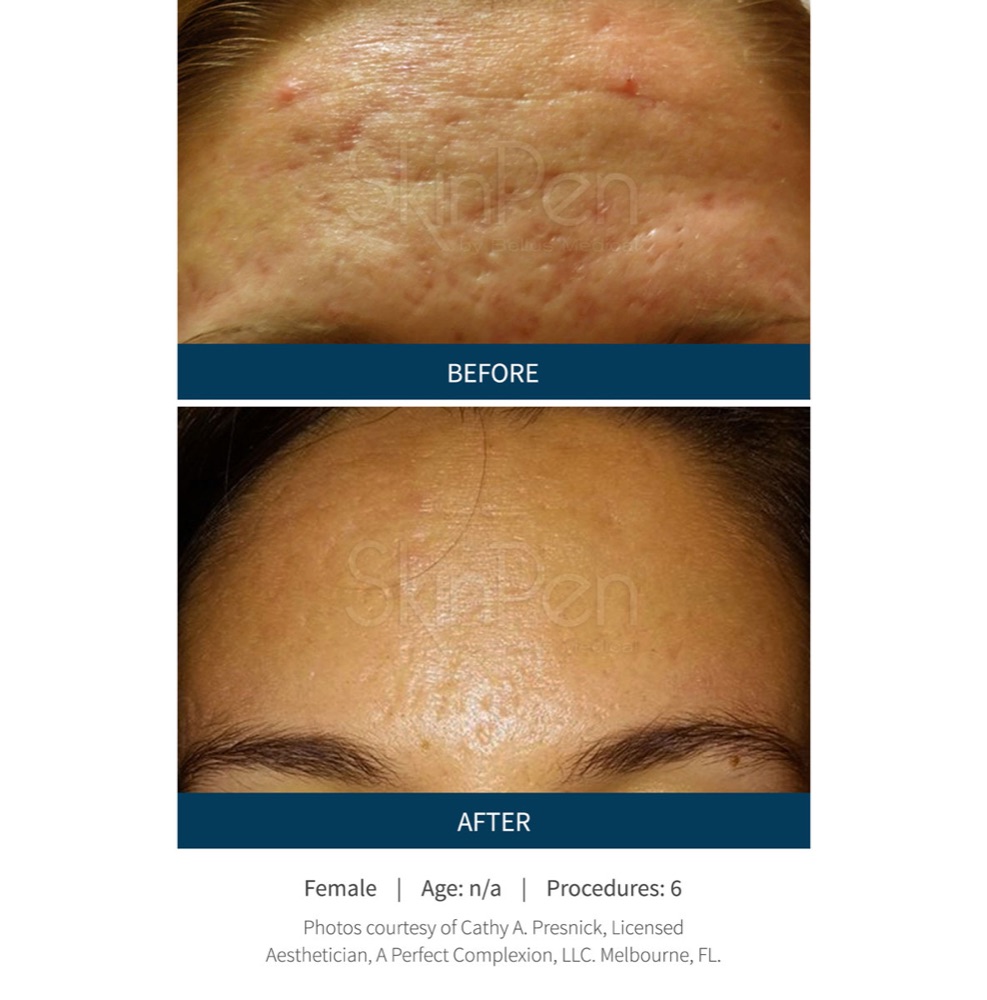 SkinPen microneedling before and after: forehead acne scarring visibly smoother after six sessions