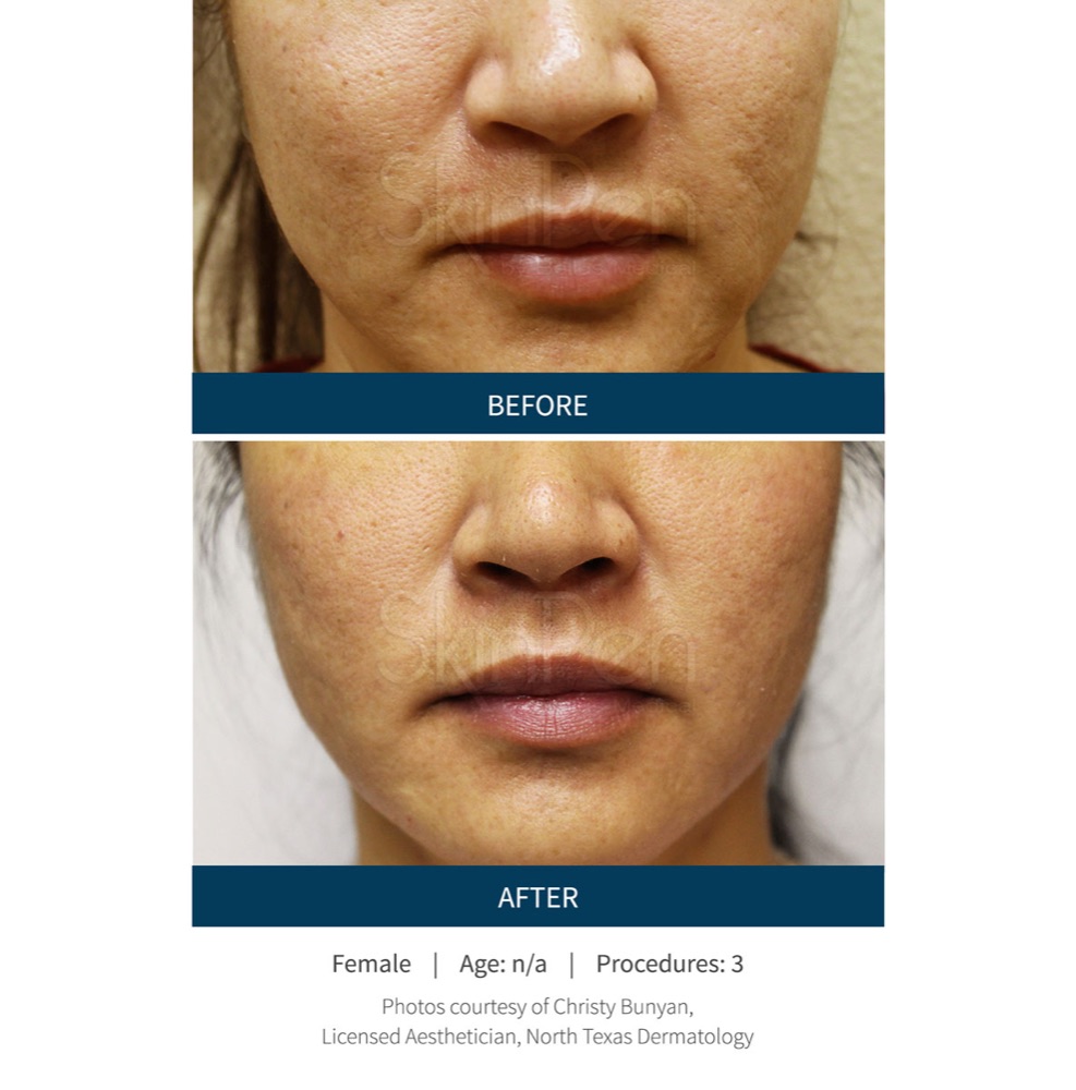 SkinPen microneedling before and after: smaller-looking pores and smoother skin around the mouth after three sessions