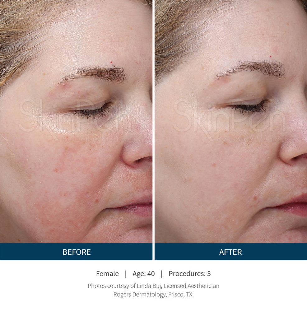 SkinPen microneedling before and after: smoother texture and more even tone on the cheek after three sessions