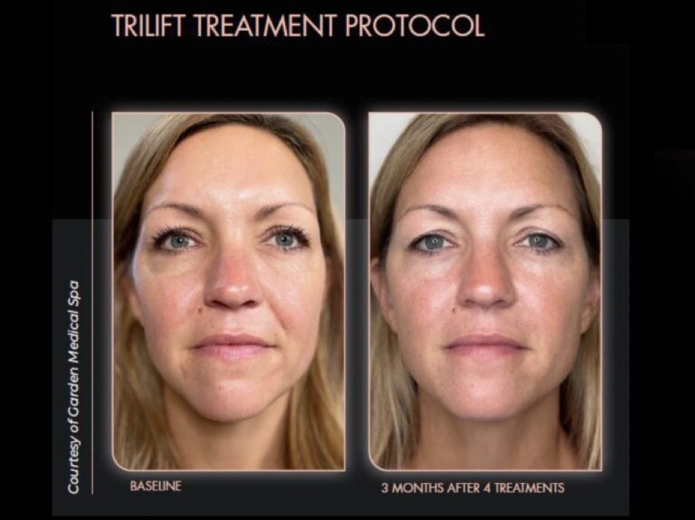 TriLift before and after: a woman's face at baseline and three months after four treatments, with firmer, more lifted skin along the cheeks and jawline