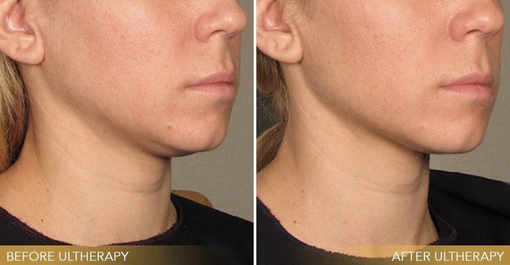 Ultherapy clinical before and after: a softer jawline and neck tightened into a more defined contour