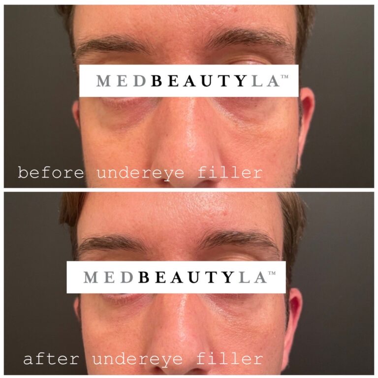 Under-eye filler before and after at MedBeautyLA: hollows and dark circles under a man's eyes filled in